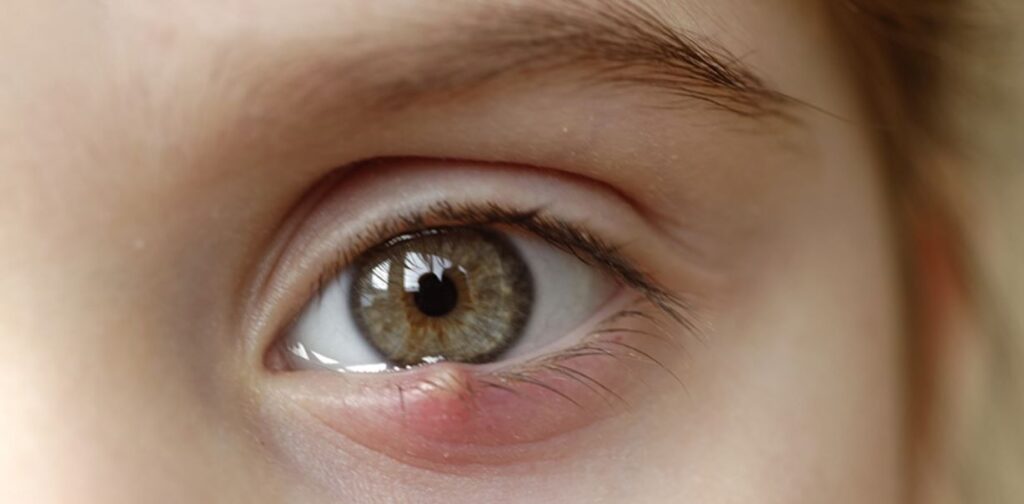 6 Ways To Look After A Stye At Home